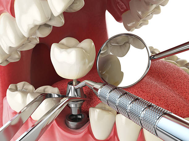 Best Emergency Dentist for Knocked-Out Tooth in Fort Morgan, CO